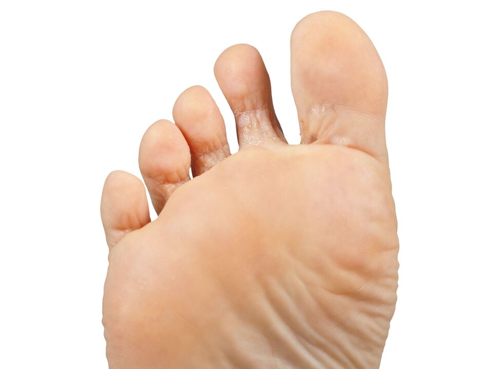 Funger-ve-Pair-ve-Heck-Cream-Demyxil